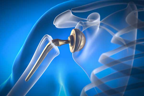 جراحة استبدال الكتف