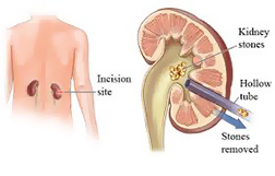 Percutaneous Nephrolithotomy PNCL Surgery