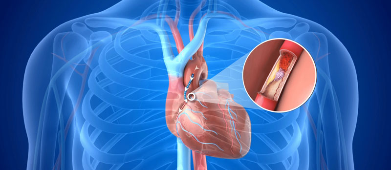 Coronary Artery Bypass Graft (CABG) Surgery Cost
